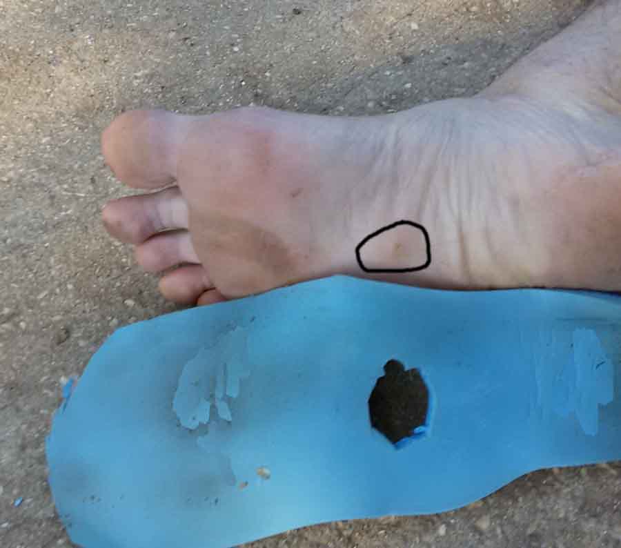 Insole to Hypoechoic / Hypoechogenic lesion